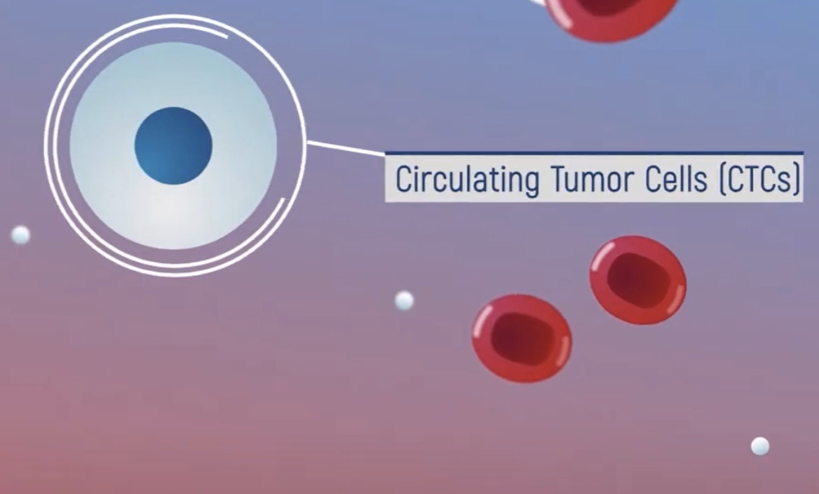 Nghiên cứu tế bào ung thư trong máu có thể sử dụng làm dấu ấn sinh học cho ung thư tuyến tiền liệt và ung thư vú di căn
